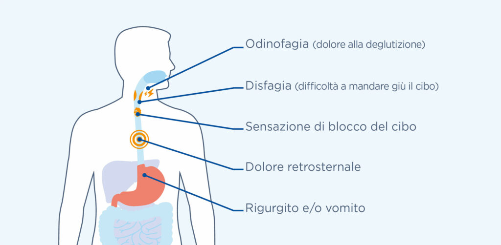 i sintomi dell'esofagite eosinofila